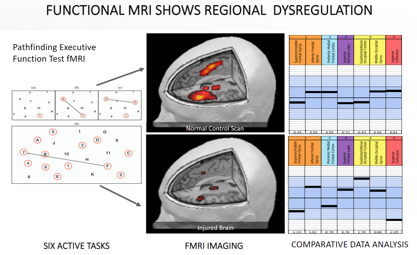 Final FMRI comparison image healthy vs injured post concussion