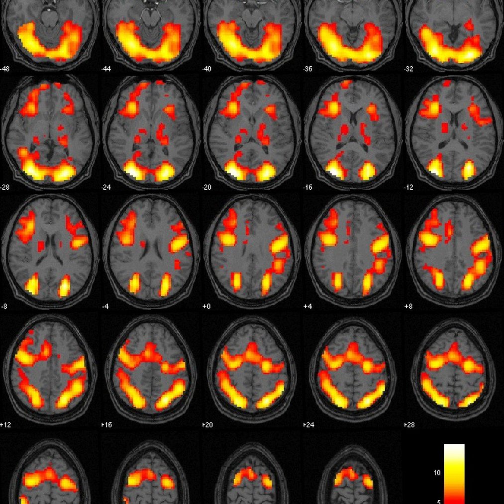 What is functional MRI and how is it different from other MRI Scans