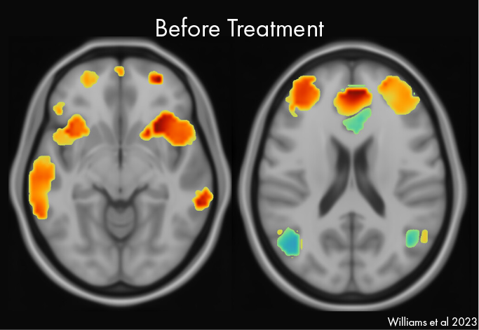 Pre and Post Tx Brains TMS-04-01