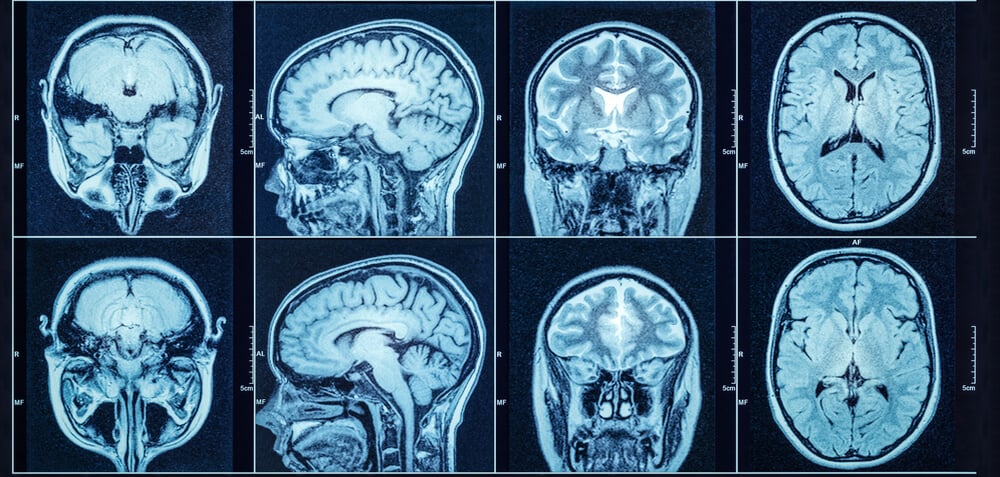 Do CT Scans Show Concussions Or Post Concussion Syndrome   Do Ct Scans Show Concussions And Pcs 2 