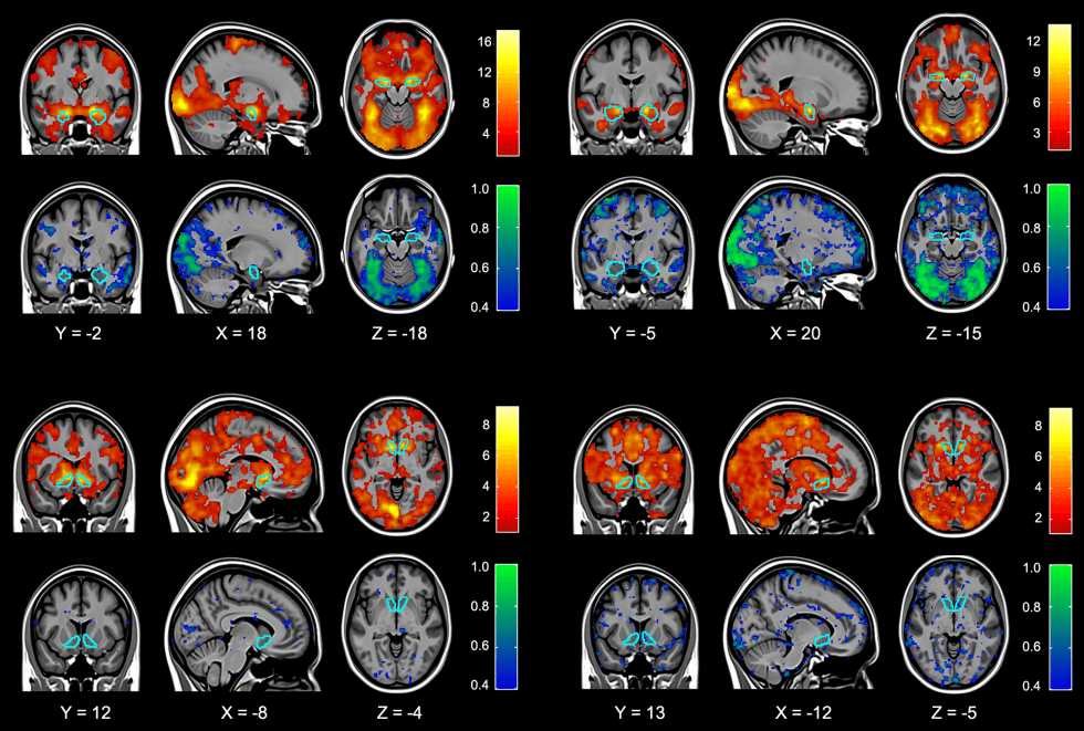 Do CT Scans Show Concussions Or Post Concussion Syndrome   Do Ct Scans Show Concussions And Pcs 6 