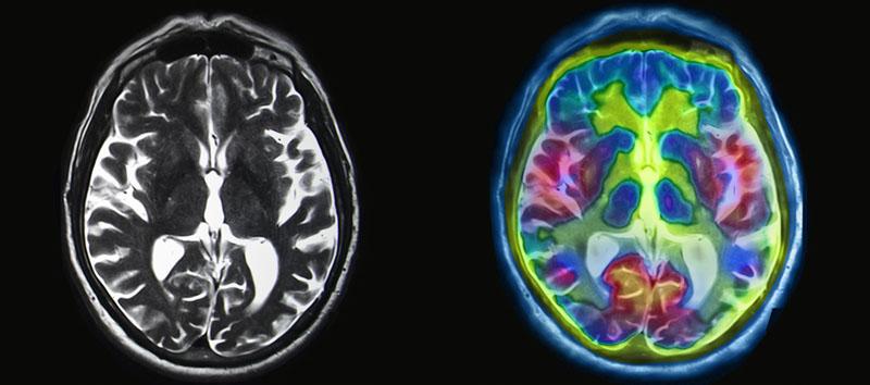 fmri-vs-spect-scan-for-the-brain-cognitive-fx