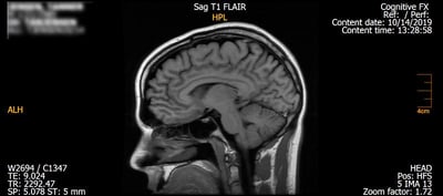 ett exempel på en fMRI