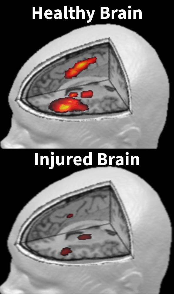 Healhty fMRI vs Injured fMRI Post Concussion Cognitive FX