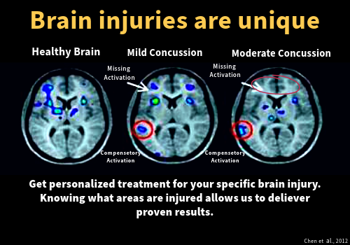 Brain Injury Are Unique Post Concussion 