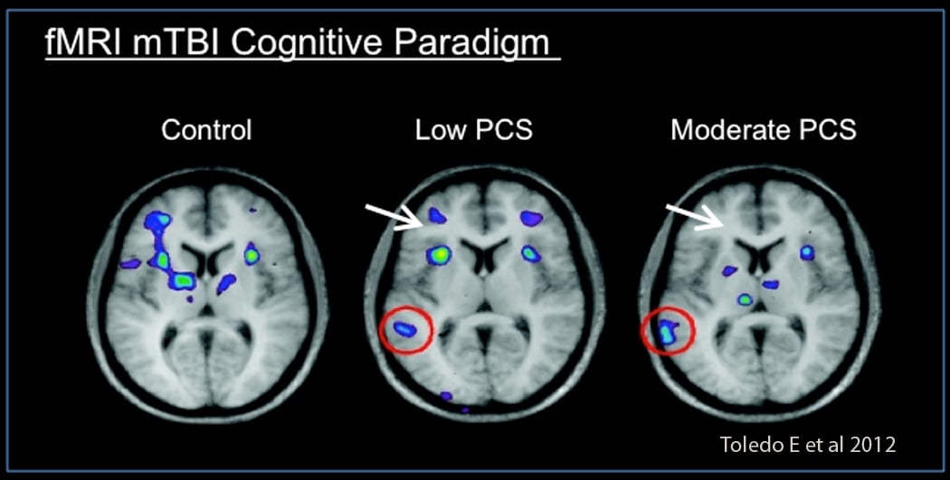 fmri Control vs Conccusion TBI